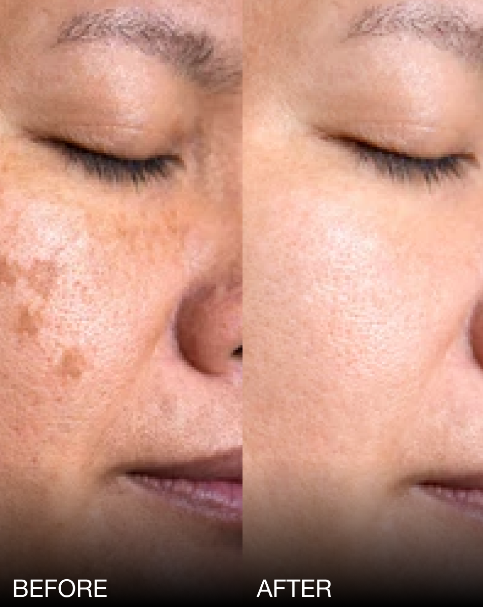 Melaclear Brightening Cream
